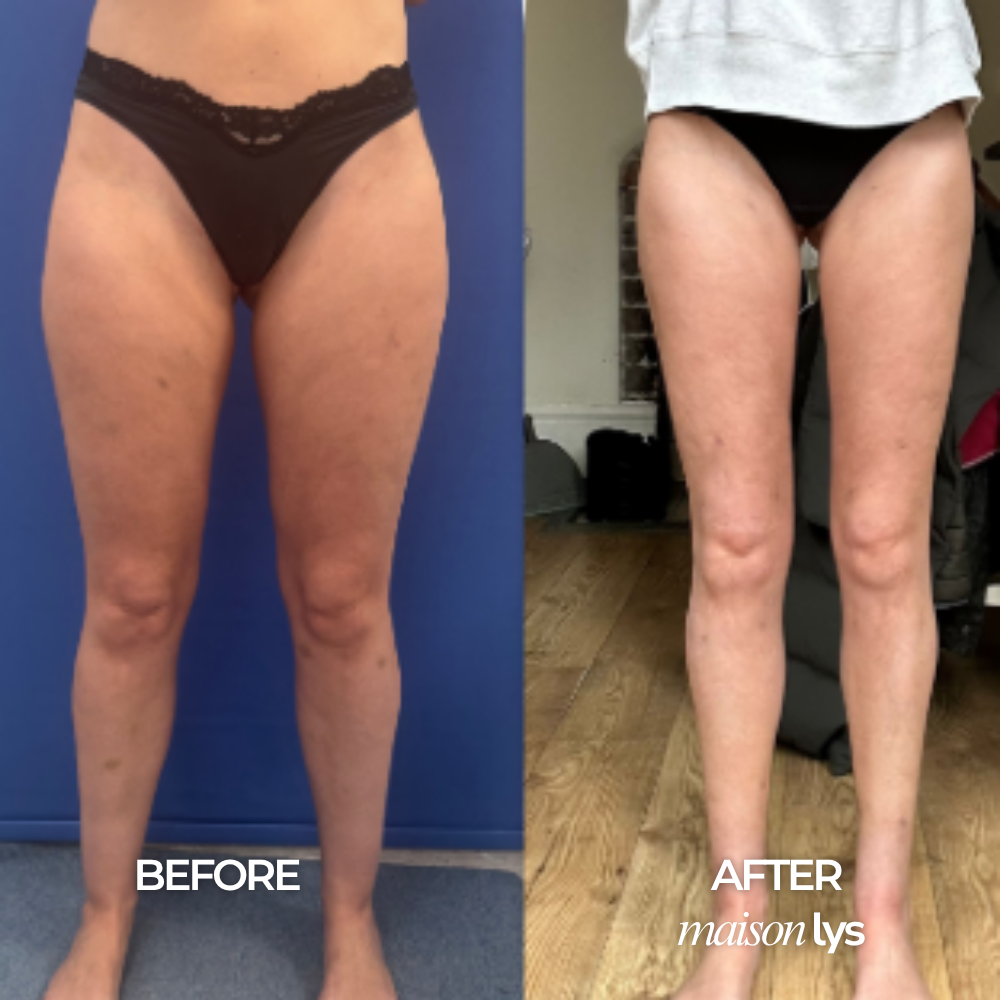 Before and after
